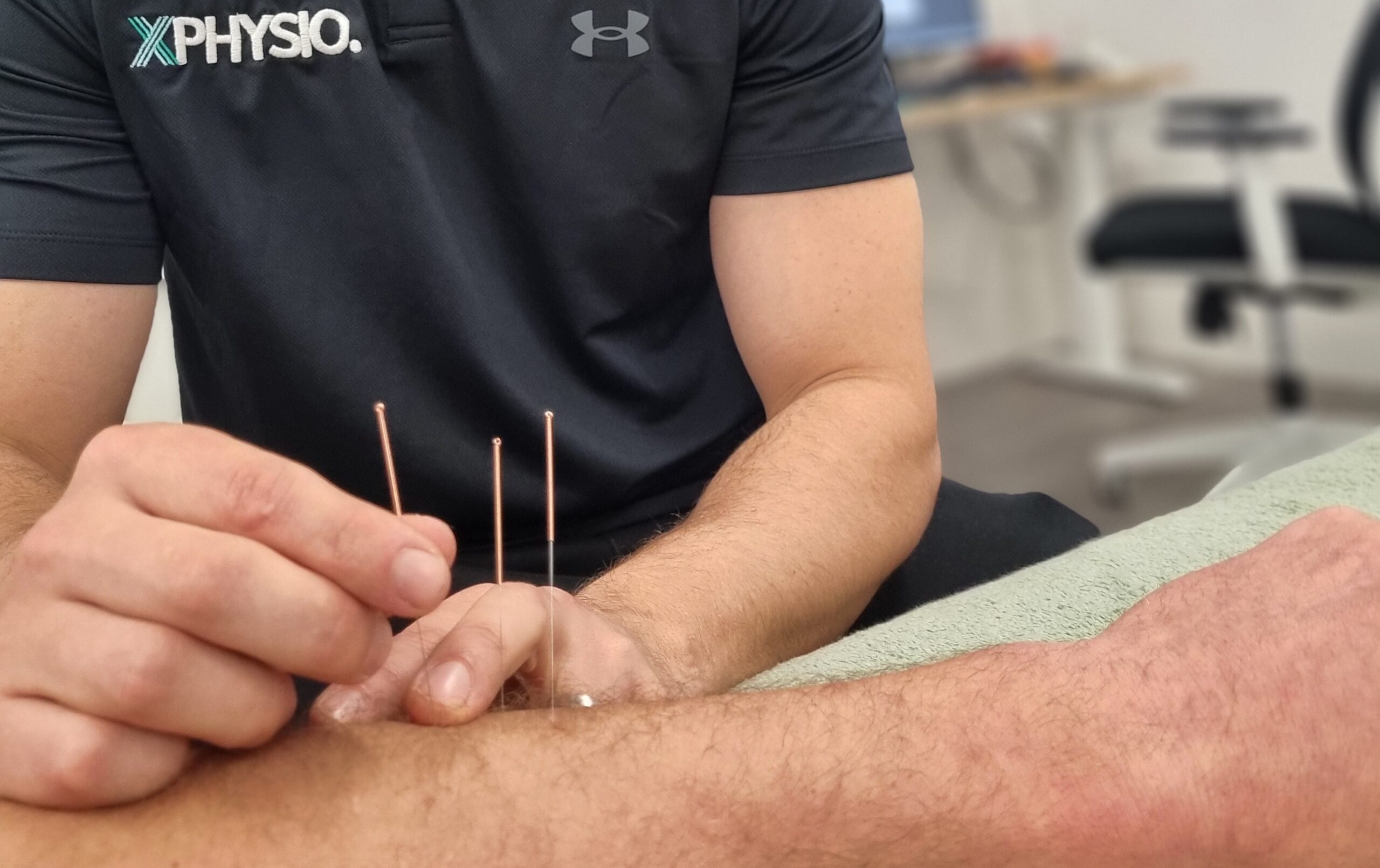 Dry needling