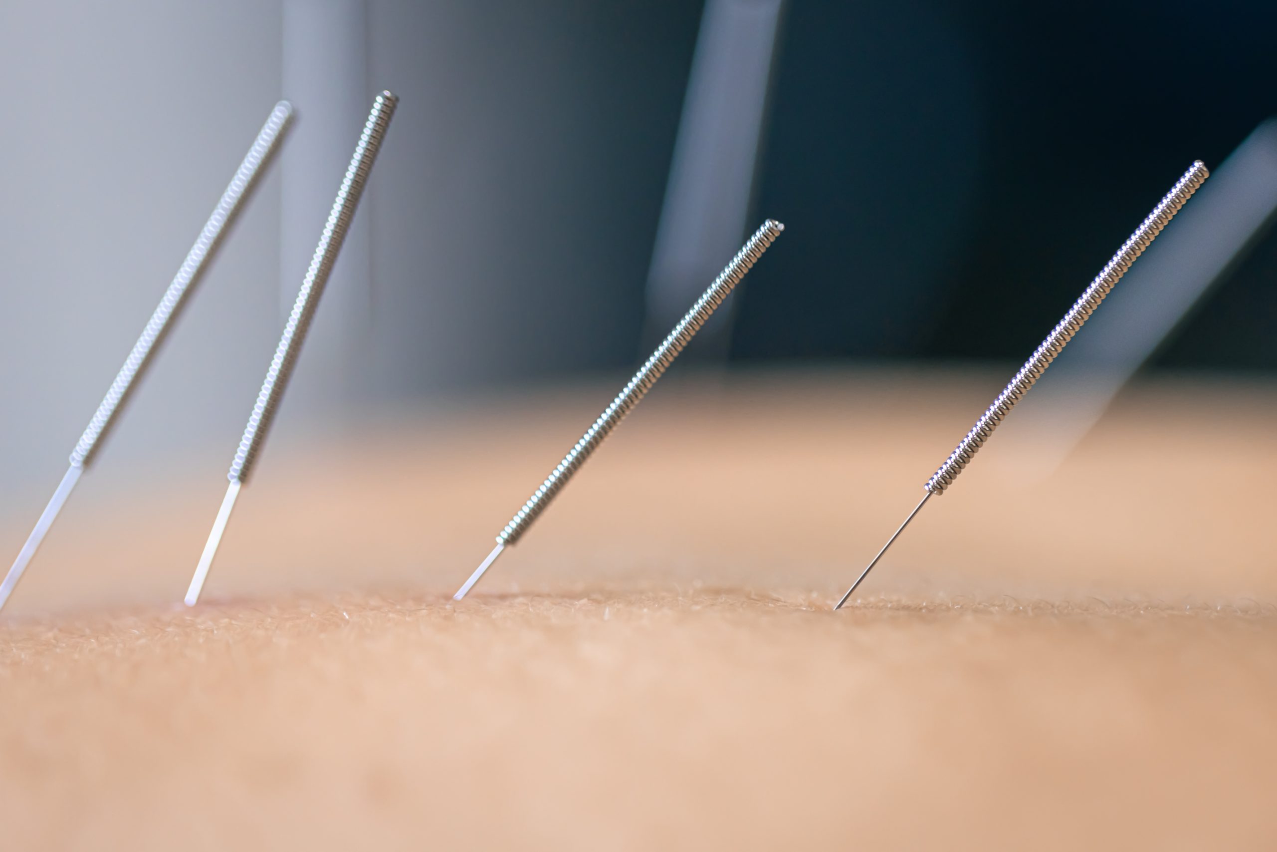 Dry needling acupuncture needles on patient, close up.