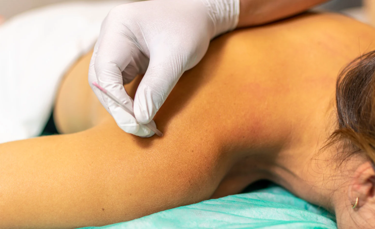 Dry Needling