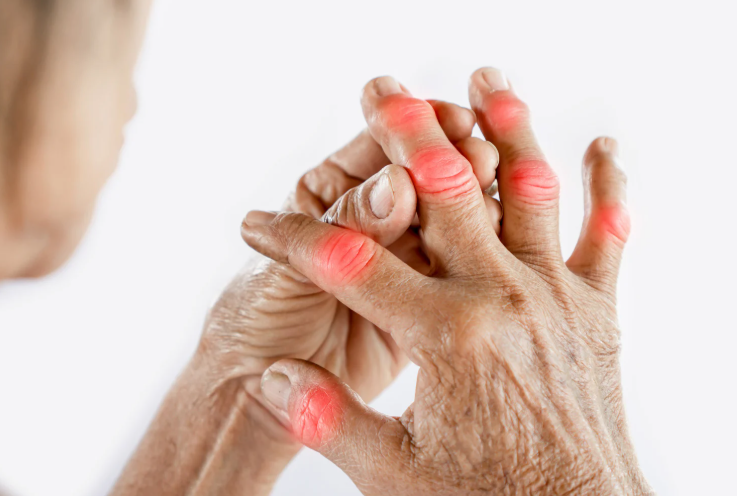 Arthritis